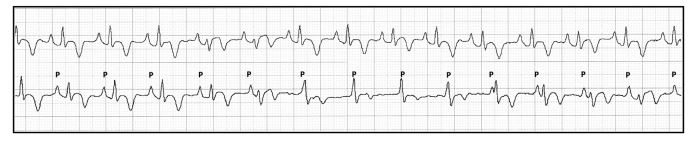 The first part of the tracing shows a sinus rhythm with a heart rate of 166 beats/min, followed by a decrease of the sinus rate to 150 beats/min